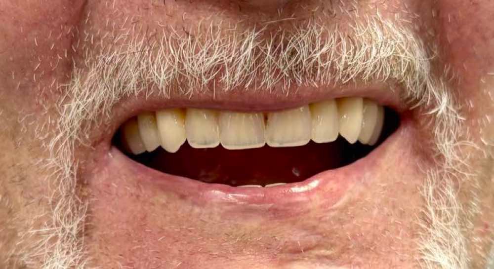 Cosmetic Dentures