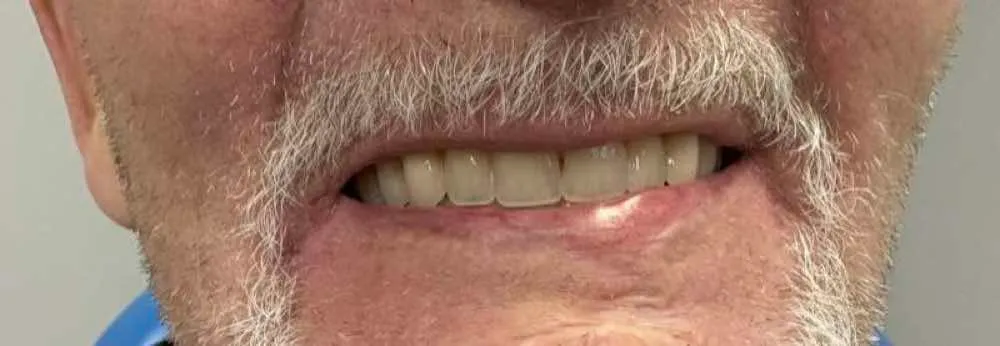enigmaLIFE+ Dentures