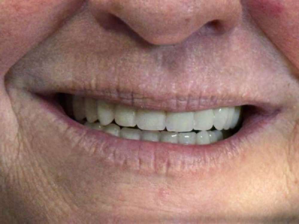 Restored smile