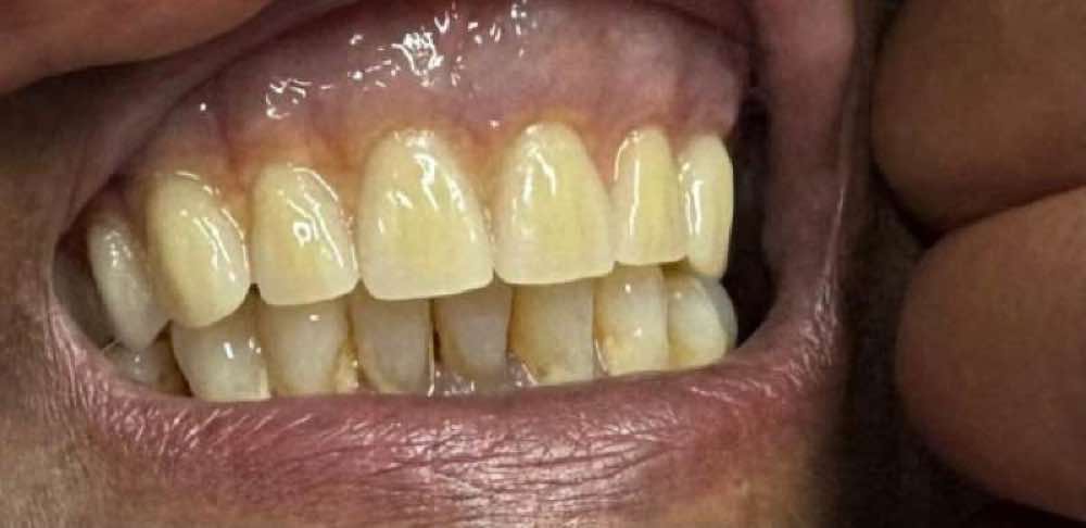 Before treatment