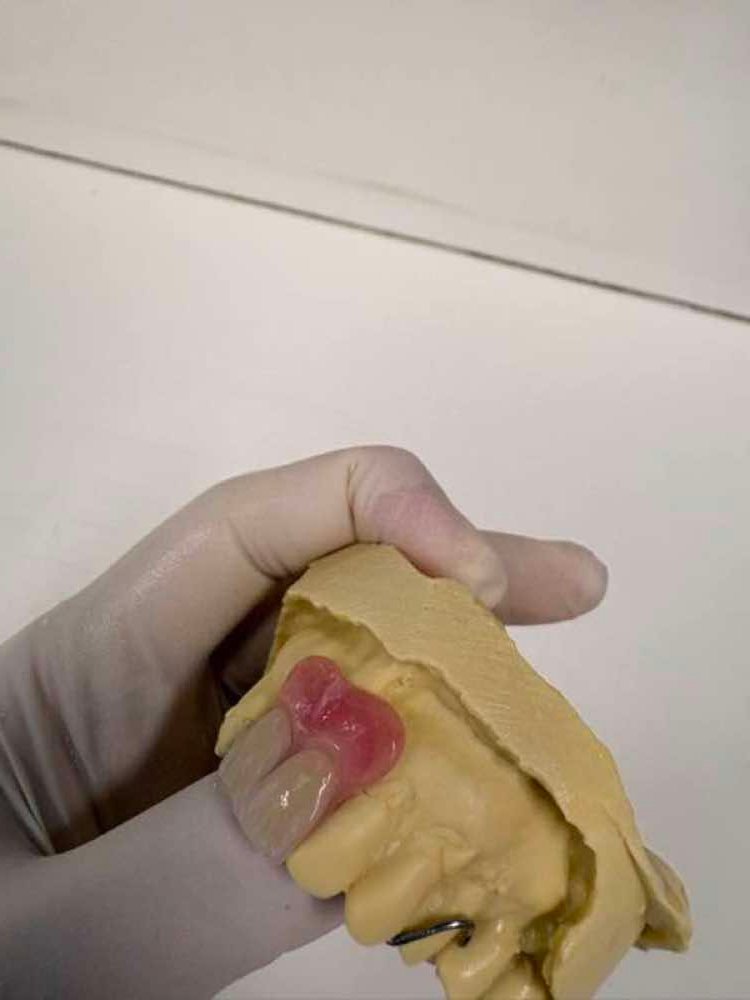 Custom denture samples